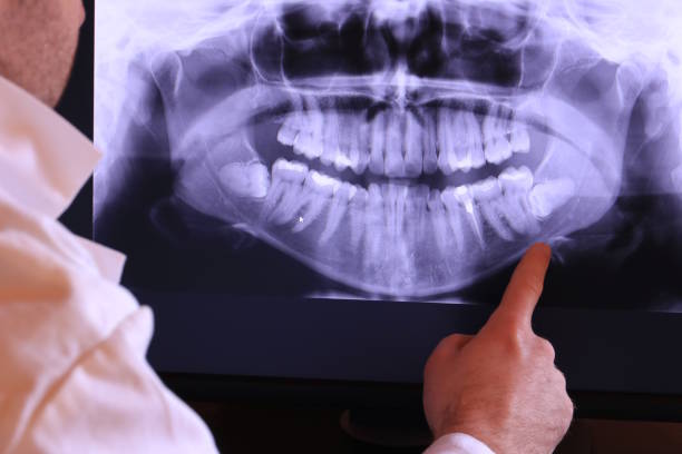 Best Knocked-Out Tooth (Avulsed Tooth) Treatment in Indian Hills, NV